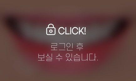 라미네이트-테트라사이클린 치아변색(진한 변색 띠 부분만 선택적 삭제)