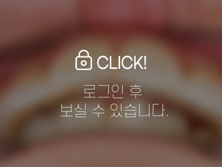4~6개월 앞니부분교정
