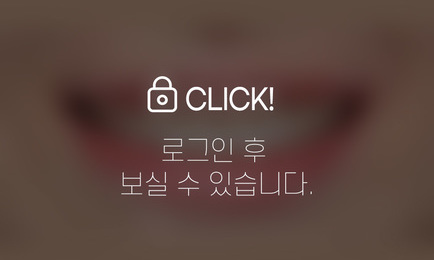 무삭제라미네이트-벌어진 앞니