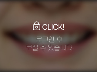 앞니 부분교정+라미네이트