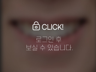 덧니 전체교정