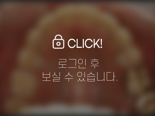 발치 전체교정