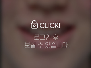 덧니 전체교정