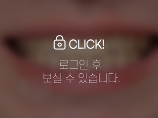 무삭제라미네이트(애드온비니어)-벌어진 앞니