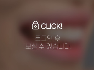 무삭제라미네이트(애드온비니어) - 벌어진 앞니