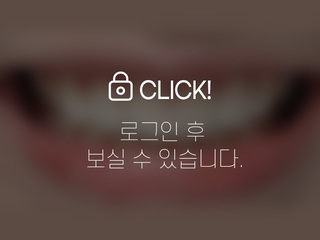 앞니교정+무삭제라미네이트