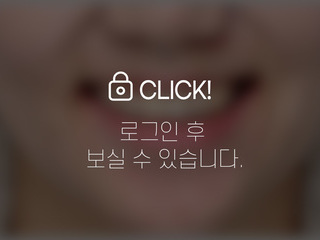 4~6개월 앞니부분교정