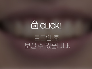 4~6개월 앞니부분교정