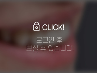 4~6개월 앞니부분교정