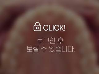 4~6개월 앞니부분교정
