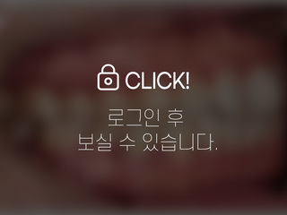 투디교정(설측교정)